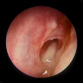 Ear Grommets - ENT Clinic Sydney